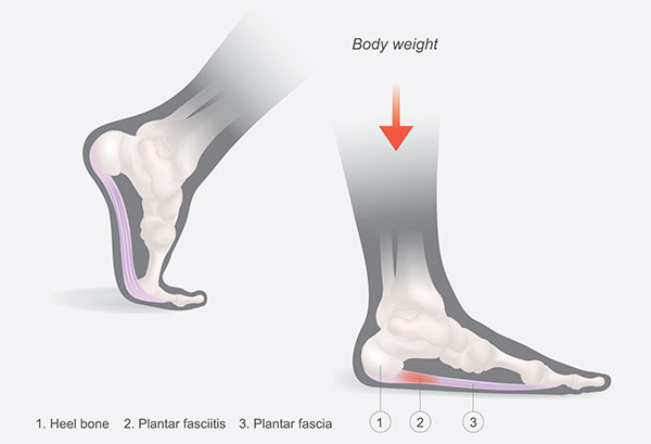 Running With Plantar Fasciitis: Illustration of Human Foot Anatomy